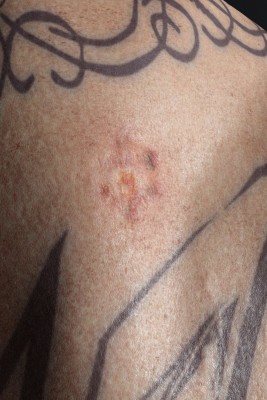 Aksel_09_Basal_cell_carcinoma.jpg